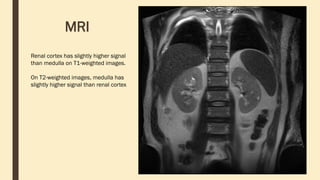 MRI
Renal cortex has slightly higher signal
than medulla on T1-weighted images.
On T2-weighted images, medulla has
slightly higher signal than renal cortex
 