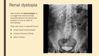 Renal dystopia
also known as renal ectopia, is
a congenital renal anomaly
characterized by the abnormal
location of one or both of
the kidneys.
They can occur in several forms:
■ cross fused renal ectopia
■ ectopic thoracic kidney
■ pelvic kidney
 
