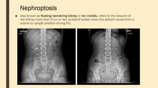 Nephroptosis
■ also known as floating/wandering kidney or ren mobilis, refers to the descent of
the kidney more than 5 cm or two vertebral bodies when the patient moves from a
supine to upright position during IVU.
 