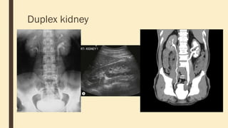 Duplex kidney
 
