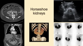 Horseshoe
kidneys
 