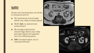 MRI
Simple cyst characteristics are similar
to ultrasound and CT:
■ T1: hypointense (hemorrhagic
debris may mildly increase signal)
■ T1 C+ (Gd): no postcontrast
enhancement
■ T2: strongly hyperintense
(hemorrhagic debris may mildly
decrease signal) and separate
from the collecting system
■ DWI: increased signal, but no
restricted diffusion
 
