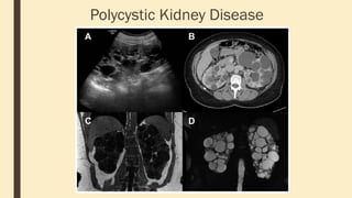 Polycystic Kidney Disease
 