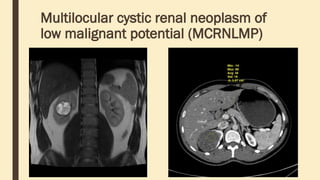 Multilocular cystic renal neoplasm of
low malignant potential (MCRNLMP)
 
