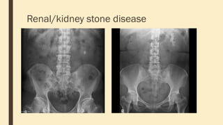 Renal/kidney stone disease
 