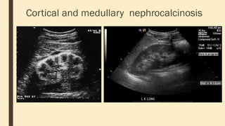 Cortical and medullary nephrocalcinosis
 