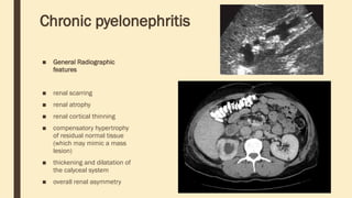 Chronic pyelonephritis
■ General Radiographic
features
■ renal scarring
■ renal atrophy
■ renal cortical thinning
■ compensatory hypertrophy
of residual normal tissue
(which may mimic a mass
lesion)
■ thickening and dilatation of
the calyceal system
■ overall renal asymmetry
 