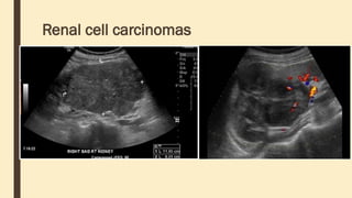 Renal cell carcinomas
 