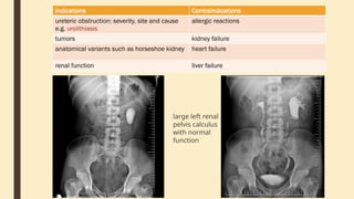 Indications Contraindications
ureteric obstruction: severity, site and cause
e.g. urolithiasis
allergic reactions
tumors kidney failure
anatomical variants such as horseshoe kidney heart failure
renal function liver failure
large left renal
pelvis calculus
with normal
function
 