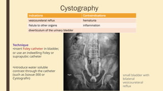 Cystography
Indications Contraindications
vesicoureteral reflux hematuria
fistula to other organs inflammation
diverticulum of the urinary bladder
Technique
•insert Foley catheter in bladder,
or use an indwelling Foley or
suprapubic catheter
•introduce water soluble
contrast through the catheter
(such as Isovue-300 or
Cystografin)
small bladder with
bilateral
vesicoureteral
reflux
 