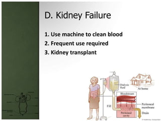 D. Kidney Failure
1. Use machine to clean blood
2. Frequent use required
3. Kidney transplant
 