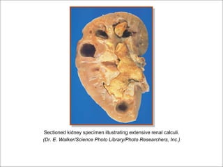 Sectioned kidney specimen illustrating extensive renal calculi.
(Dr. E. Walker/Science Photo Library/Photo Researchers, Inc.)
 