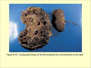 Figure 9.10 – A polycystic kidney on the left compared to a normal kidney on the right.
 