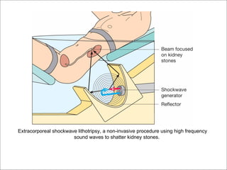 Extracorporeal shockwave lithotripsy, a non-invasive procedure using high frequency
                       sound waves to shatter kidney stones.
 