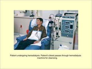 Patient undergoing hemodialysis. Patient’s blood passes through hemodialysis
                            machine for cleansing.
 