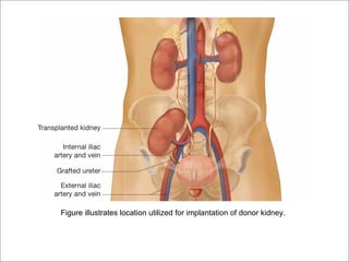 Figure illustrates location utilized for implantation of donor kidney.
 