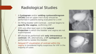Urinary Tract Fistulas -(VVF) Etiology, Diagnosis, Management | PDF