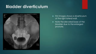 Bladder diverticulum
 IVU images shows a diverticulum
at the right lateral wall.
 Note the elevated base of the
bladder due to the enlarged
prostate.
 
