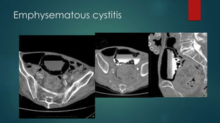 Emphysematous cystitis
 