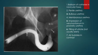 1.Balloon of catheter in
navicular fossa
2. Penile urethra
3. Bulbous urethra
4. Membranous urethra
5. Impression of
verumontanum in
prostatic urethra
6. Filling of utricle (not
usually seen)
7. Air bubbles in
contrast
 
