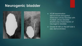 Neurogenic bladder
 VCUR examination
demonstrate elongated
distended urinary bladder with
multiple urinary bladder
diverticulae characteristic of
neurogenic bladder.
 Grade III VUR on the left side is
also demonstrated.
 
