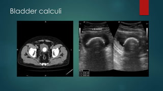 Bladder calculi
 