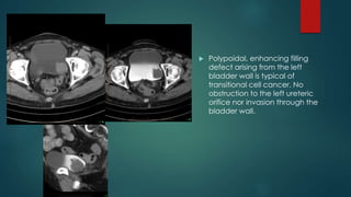 Polypoidal, enhancing filling
defect arising from the left
bladder wall is typical of
transitional cell cancer. No
obstruction to the left ureteric
orifice nor invasion through the
bladder wall.
 