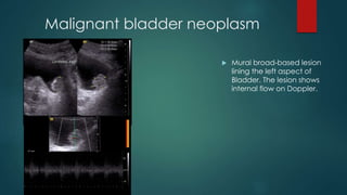 Malignant bladder neoplasm
 Mural broad-based lesion
lining the left aspect of
Bladder. The lesion shows
internal flow on Doppler.
 