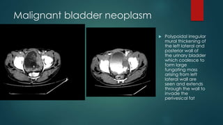 Malignant bladder neoplasm
 Polypoidal irregular
mural thickening of
the left lateral and
posterior wall of
the urinary bladder
which coalesce to
form large
fungating mass
arising from left
lateral wall are
seen and extends
through the wall to
invade the
perivesical fat
 
