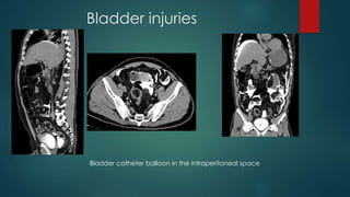 Bladder injuries
Bladder catheter balloon in the intraperitoneal space
 