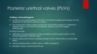 Posterior urethral valves (PUVs)
Voiding cystourethrogram
 Voiding cystourethrogram (VCUG) is the best imaging technique for the
diagnosis of posterior urethral valves.
 The diagnosis is best made during the micturition phase in a lateral or
oblique views, such that the posterior urethra can be imaged
adequately .
Findings include :
 dilatation and elongation of the posterior urethra (equivalent of the
ultrasonographic keyhole sign)
 linear radiolucent band corresponding to the valve (only occasionally
seen)
 vesicoureteral reflux (VUR): seen in 50% of patients .
 bladder trabeculation/diverticula
 