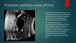 Posterior urethral valves (PUVs)
 Keyhole sign Rotated image of an
antenatal ultrasound of the foetal
pelvis demonstrating the keyhole
sign, created by the distend
bladder and posterior urethra.
 The keyhole sign is an
ultrasonograhic sign seen in boys
with posterior urethral valves. It
refers to the appearance of
posterior urethra which is dilated,
and associated thick walled
distended bladder which on
ultrasound may resemble a key
hole.
 