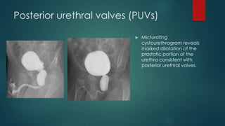 Posterior urethral valves (PUVs)
 Micturating
cystourethrogram reveals
marked dilatation of the
prostatic portion of the
urethra consistent with
posterior urethral valves.
 