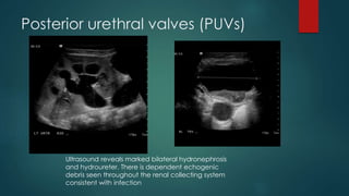 Posterior urethral valves (PUVs)
Ultrasound reveals marked bilateral hydronephrosis
and hydroureter. There is dependent echogenic
debris seen throughout the renal collecting system
consistent with infection
 