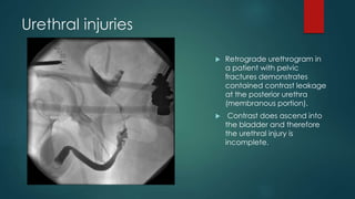 Urethral injuries
 Retrograde urethrogram in
a patient with pelvic
fractures demonstrates
contained contrast leakage
at the posterior urethra
(membranous portion).
 Contrast does ascend into
the bladder and therefore
the urethral injury is
incomplete.
 