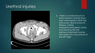 Urethral injuries
 there is a small amount of
extravasated contrast (from
prior urethrogram) within the
retro-pubic space (cave of
Retzius), inferior
extraperitoneal pelvic cavity
and tracking into the
perineum/perineal muscles
and adductor musculature of
the left thigh
 
