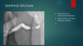 Urethral stricture
 Past history of
chlamyida infection.
 20mm stricture in the
bulbous urethra.

 