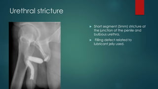 Urethral stricture
 Short segment (5mm) stricture at
the junction of the penile and
bulbous urethra.
 Filling defect related to
lubricant jelly used.
 