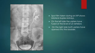  Spot film taken during an IVP shows
bilateral duplex kidneys.
 On the left side the ureters have
fused at the level of L3 vertebra
 On the right side both ureters have
opened into the bladder.
 