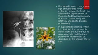  Drooping lily sign - a urographic
sign of duplicated renal
collecting system. It refers to the
inferolateral displacement of
the opacified lower pole moiety
due to an obstructed (and
relatively unopacified) upper
pole moiety.
 In duplicated collecting system
it is classically the upper pole
ureter that is obstructed due to
a ureterocoele and the lower
pole ureter that refluxes: as
described by the Weigert-Meyer
law.
 