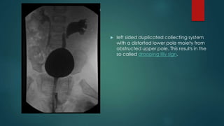  left sided duplicated collecting system
with a distorted lower pole moiety from
obstructed upper pole. This results in the
so called drooping lilly sign.
 