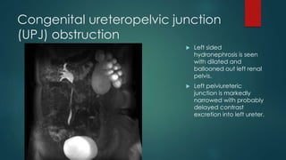 Congenital ureteropelvic junction
(UPJ) obstruction
 Left sided
hydronephrosis is seen
with dilated and
ballooned out left renal
pelvis.
 Left pelviureteric
junction is markedly
narrowed with probably
delayed contrast
excretion into left ureter.
 