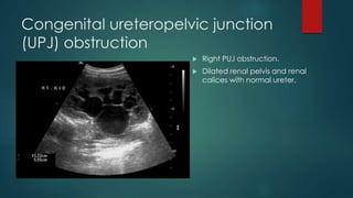 Congenital ureteropelvic junction
(UPJ) obstruction
 Right PUJ obstruction.
 Dilated renal pelvis and renal
calices with normal ureter.
 