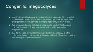 Congenital megacalyces
 is an incidental finding which mimics hydronephrosis. It is a result of
underdevelopment of the renal medullary pyramids with resultant
enlargement of the calyces. It it more frequently seen in males.
 The enlarged, floppy calyces predispose to stasis, infection and
calculus formation. There is an association with congenital
megaureter.
 due to the lack of normal medullary pyramids, not only are the
calyces enlarged but they lack the normal imprint from the papillae,
thus having a flat appearance.
 