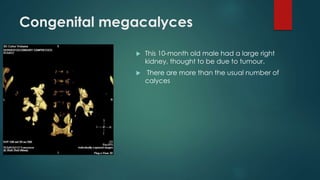 Congenital megacalyces
 This 10-month old male had a large right
kidney, thought to be due to tumour.
 There are more than the usual number of
calyces
 