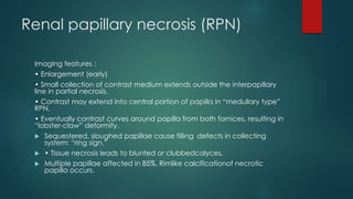 Renal papillary necrosis (RPN)
Imaging features :
• Enlargement (early)
• Small collection of contrast medium extends outside the interpapillary
line in partial necrosis.
• Contrast may extend into central portion of papilla in “medullary type”
RPN.
• Eventually contrast curves around papilla from both fornices, resulting in
“lobster-claw” deformity.
 Sequestered, sloughed papillae cause filling defects in collecting
system: “ring sign.”
 • Tissue necrosis leads to blunted or clubbedcalyces.
 Multiple papillae affected in 85%. Rimlike calcificationof necrotic
papilla occurs.
 
