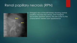 Renal papillary necrosis (RPN)
 Enlarged view of the left kidney showing central
papillary necrosis (top arrow), and marginal
excavation (bottom arrow), the pre-cursor to the
characteristic lobster claw appearance
 