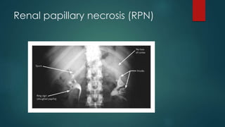 Renal papillary necrosis (RPN)
 