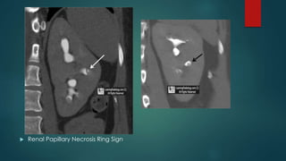  Renal Papillary Necrosis Ring Sign
 