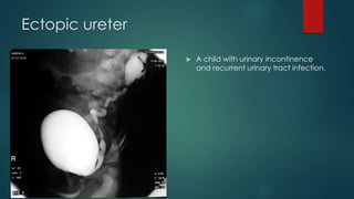 Ectopic ureter
 A child with urinary incontinence
and recurrent urinary tract infection.
 